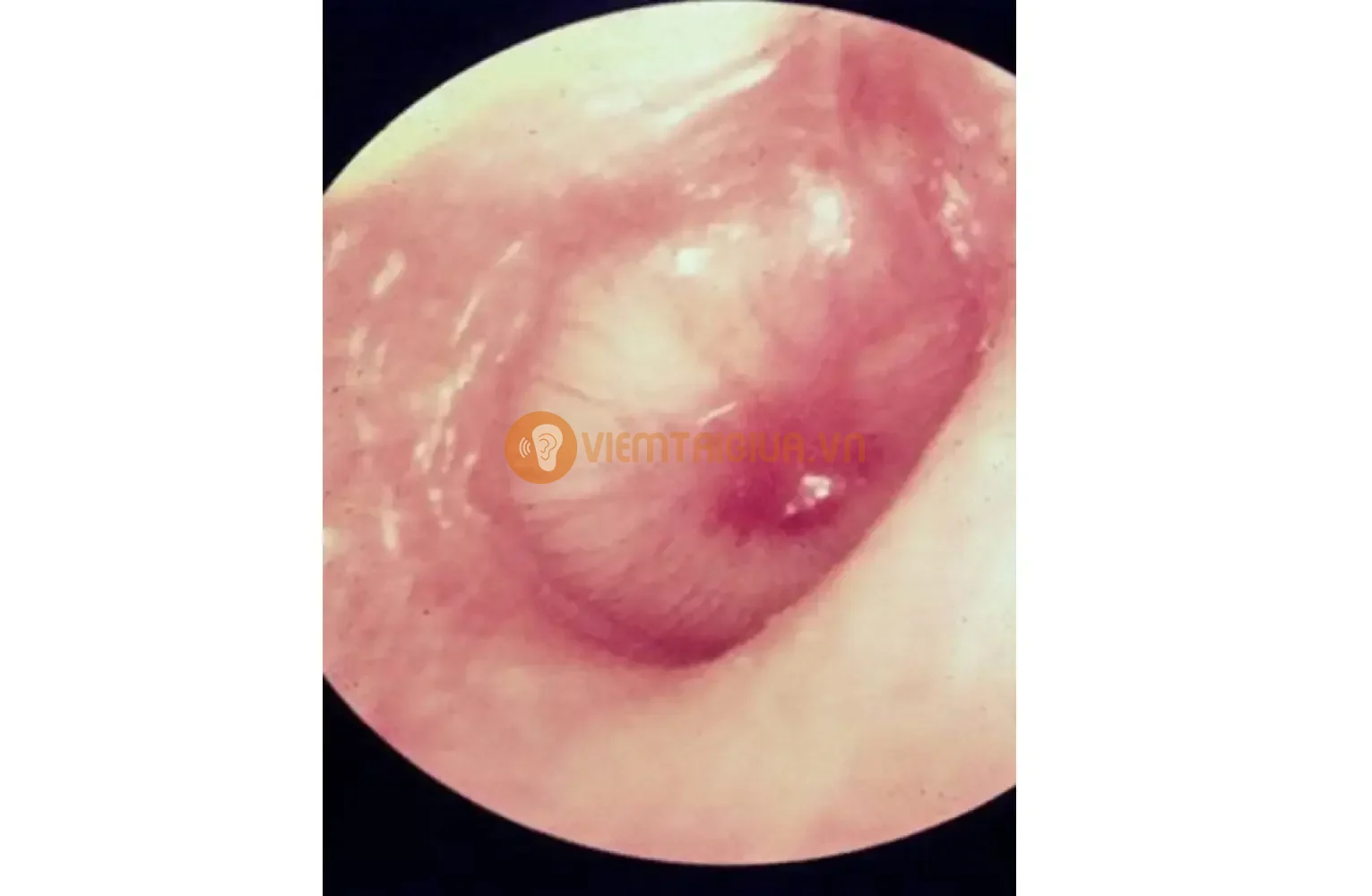 Hình ảnh màng nhĩ căng phồng do dịch mủ gây ra bởi viêm tai giữa cấp tính