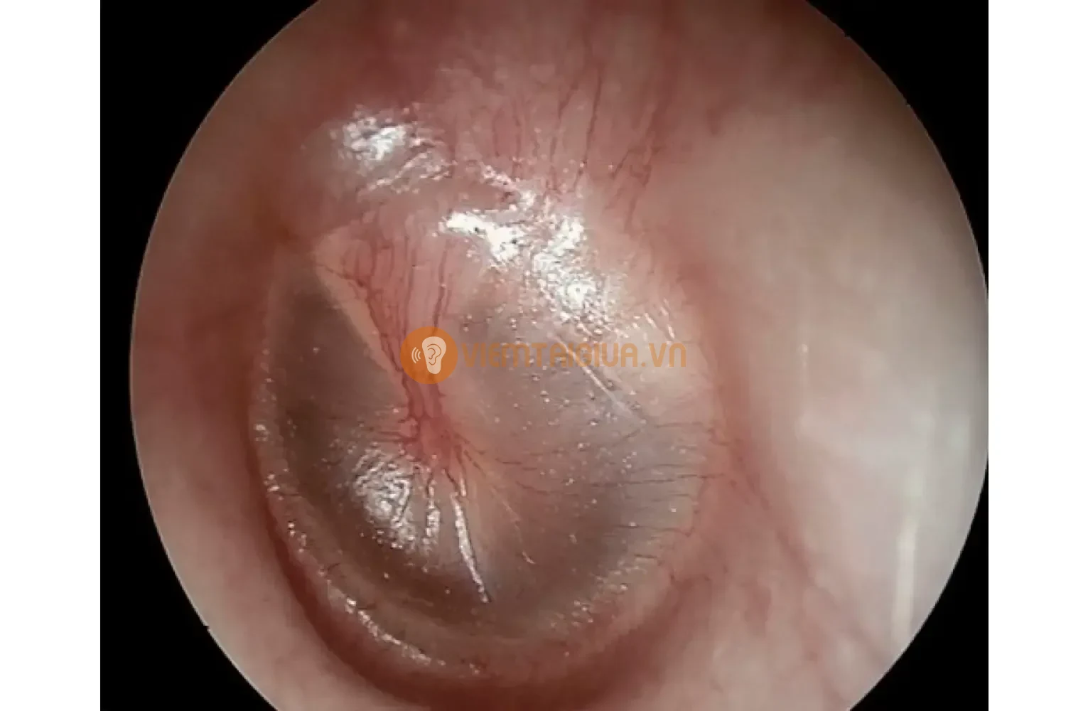 Viêm tai giữa cấp tính không có dịch mủ do virus