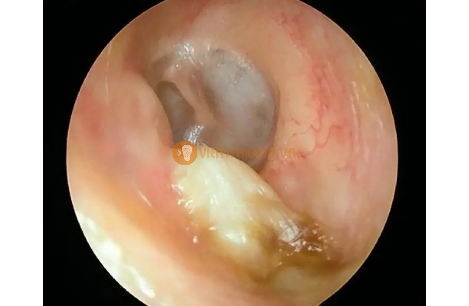 Bệnh lý nhiễm trùng tạo khối u trong tai chứa các mảnh tế bào chết và bã nhờn - Cholesteatoma