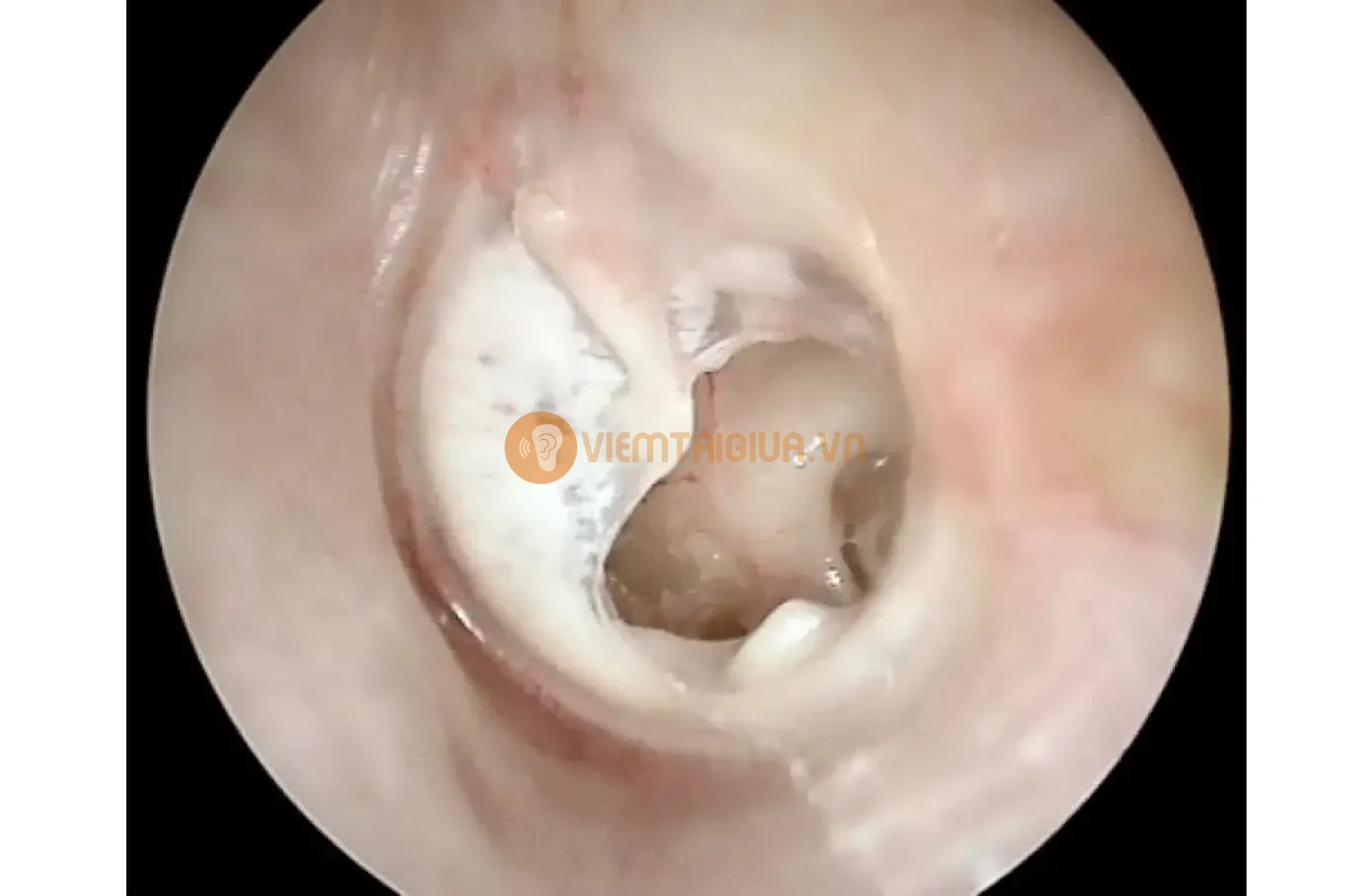 Hình ảnh màng nhĩ xuất hiện lỗ thủng do quá trinh xơ hóa