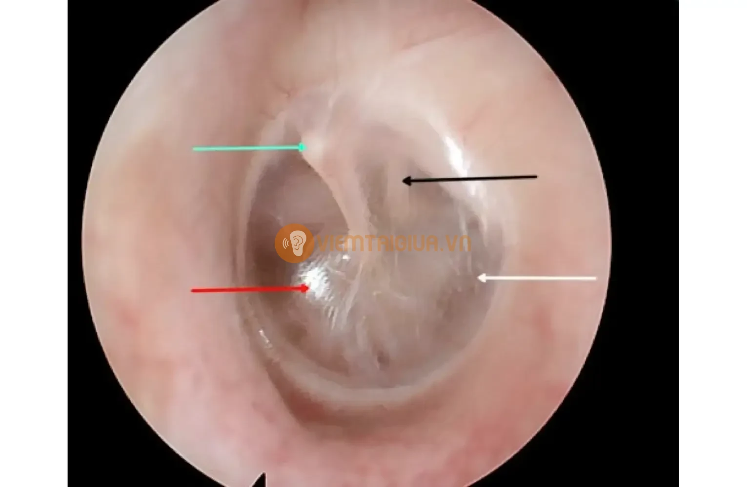 Hình ảnh tai của một người khỏe mạnh không mắc bệnh lý về tai