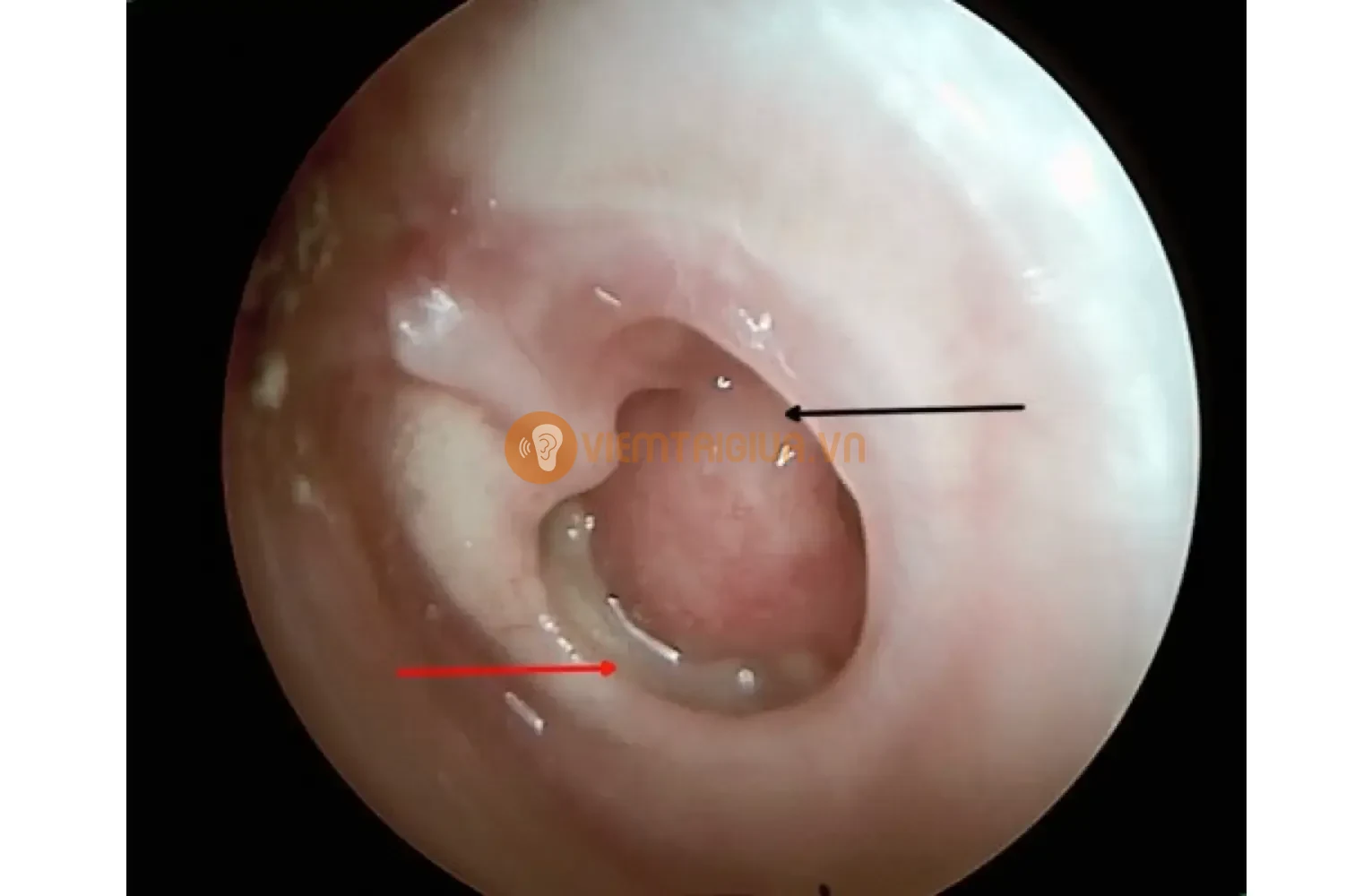 Tình trạng thủng màng nhĩ do nhiễm trùng