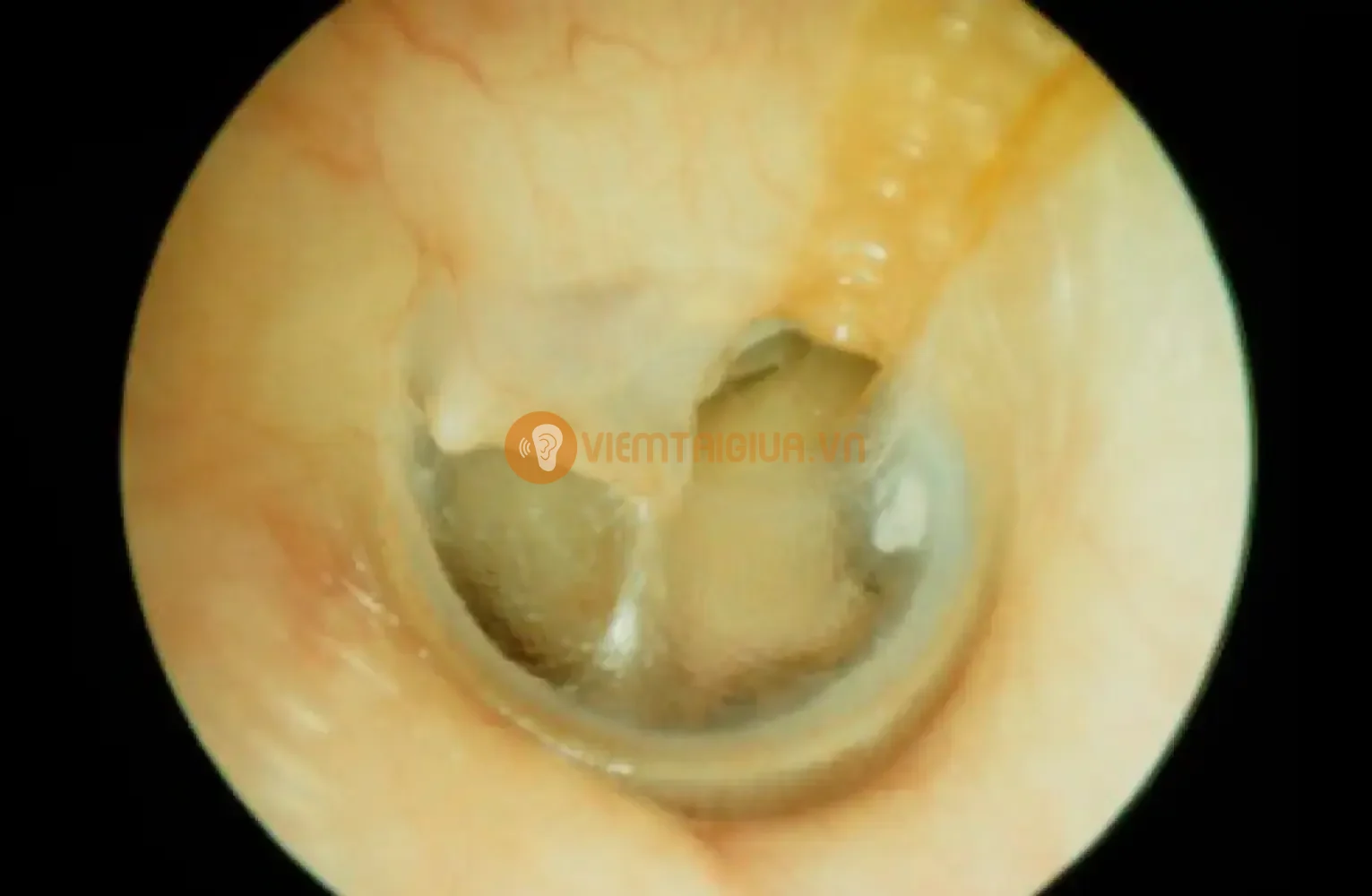 Hiện tưởng thủng màng nhĩ nghi ngờ do bênh lý viêm tai giữa cấp tính