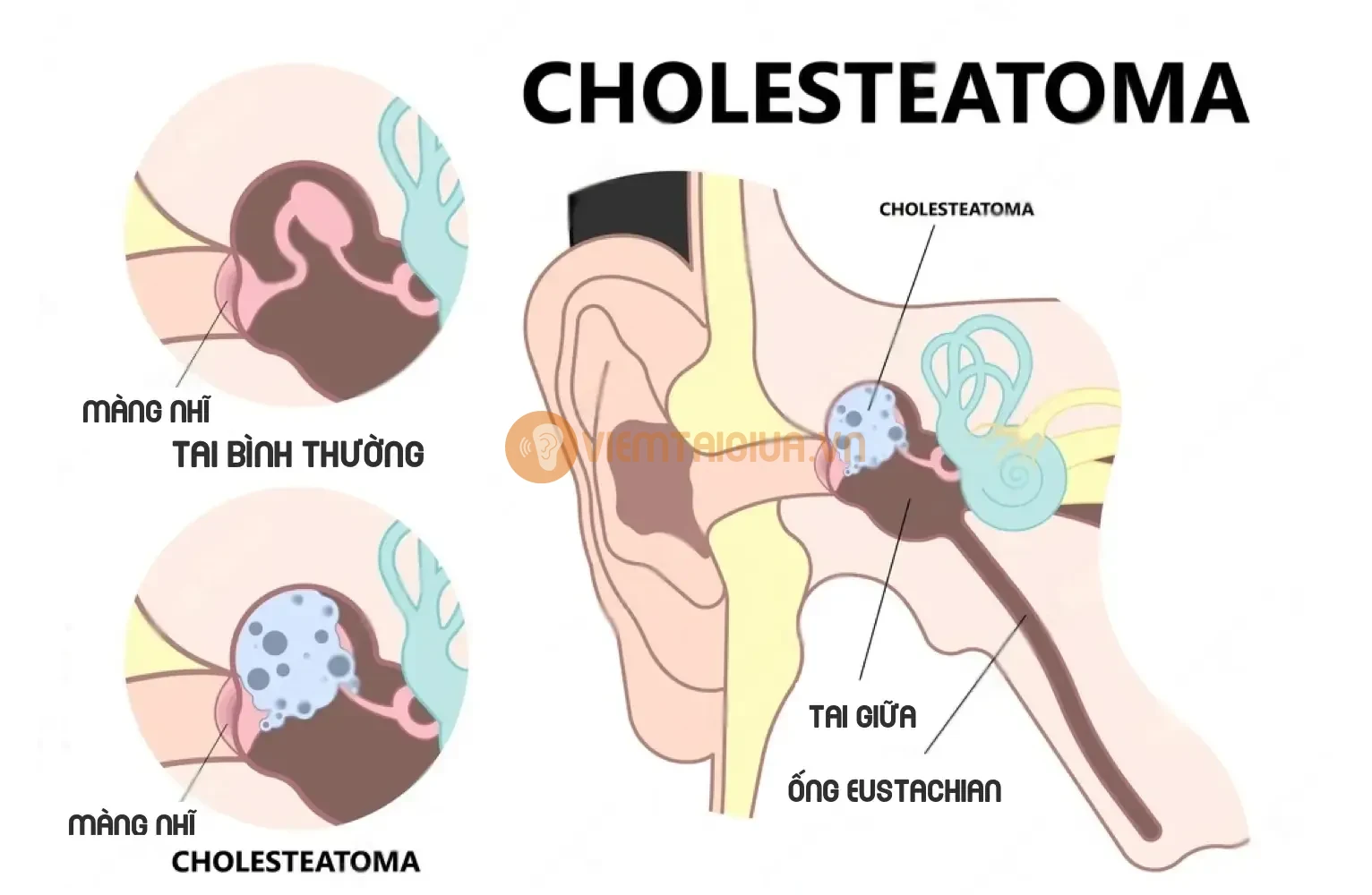 Cholesteatoma là một khối u bã chứa các tế bào da chết xuất hiện trong tai giữa