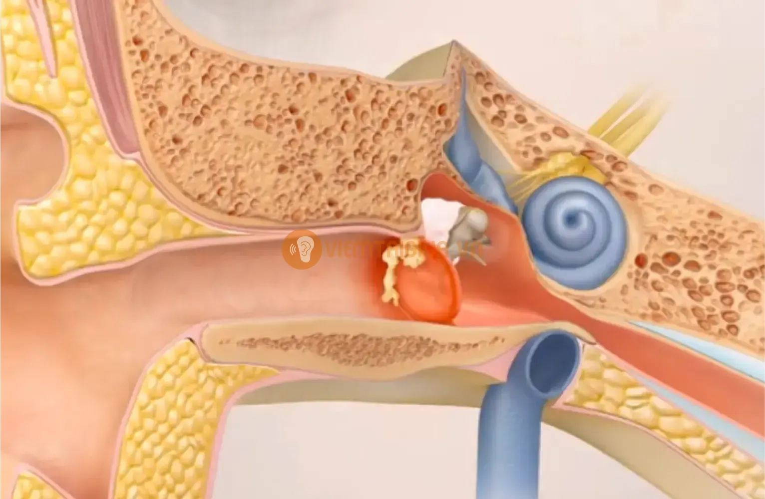 Hiểu rõ về cholesteatoma giúp các phụ huynh chủ động trong việc phòng ngừa cho con trẻ