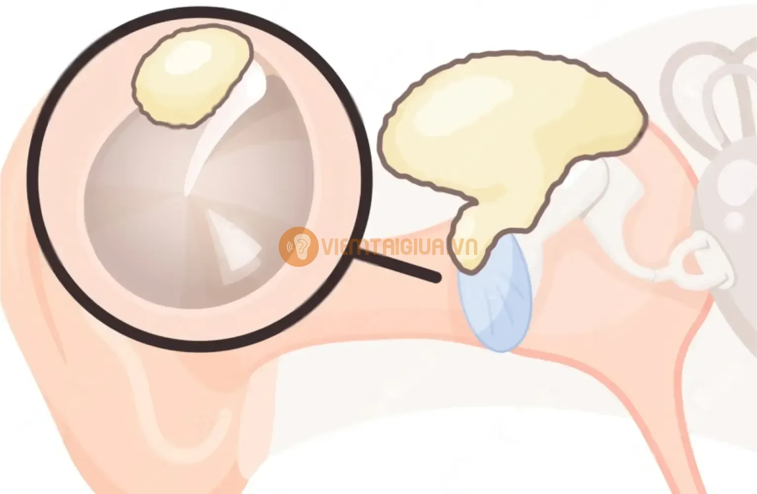 Cholesteatoma là bệnh lý phổ biến ở trẻ em