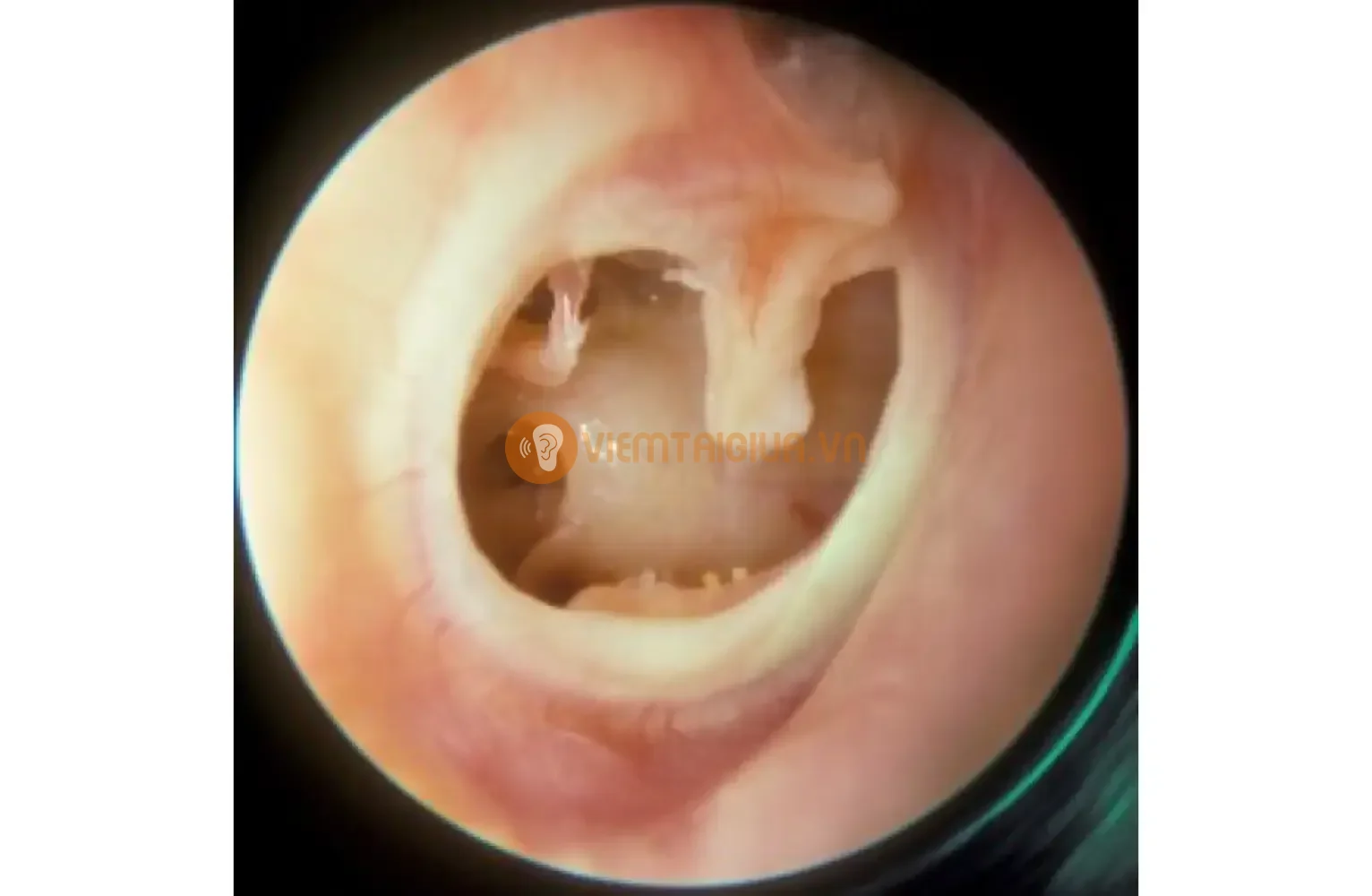Hình ảnh các xương xốp trong tai giữa bị ăn mòn do viêm nhiễm