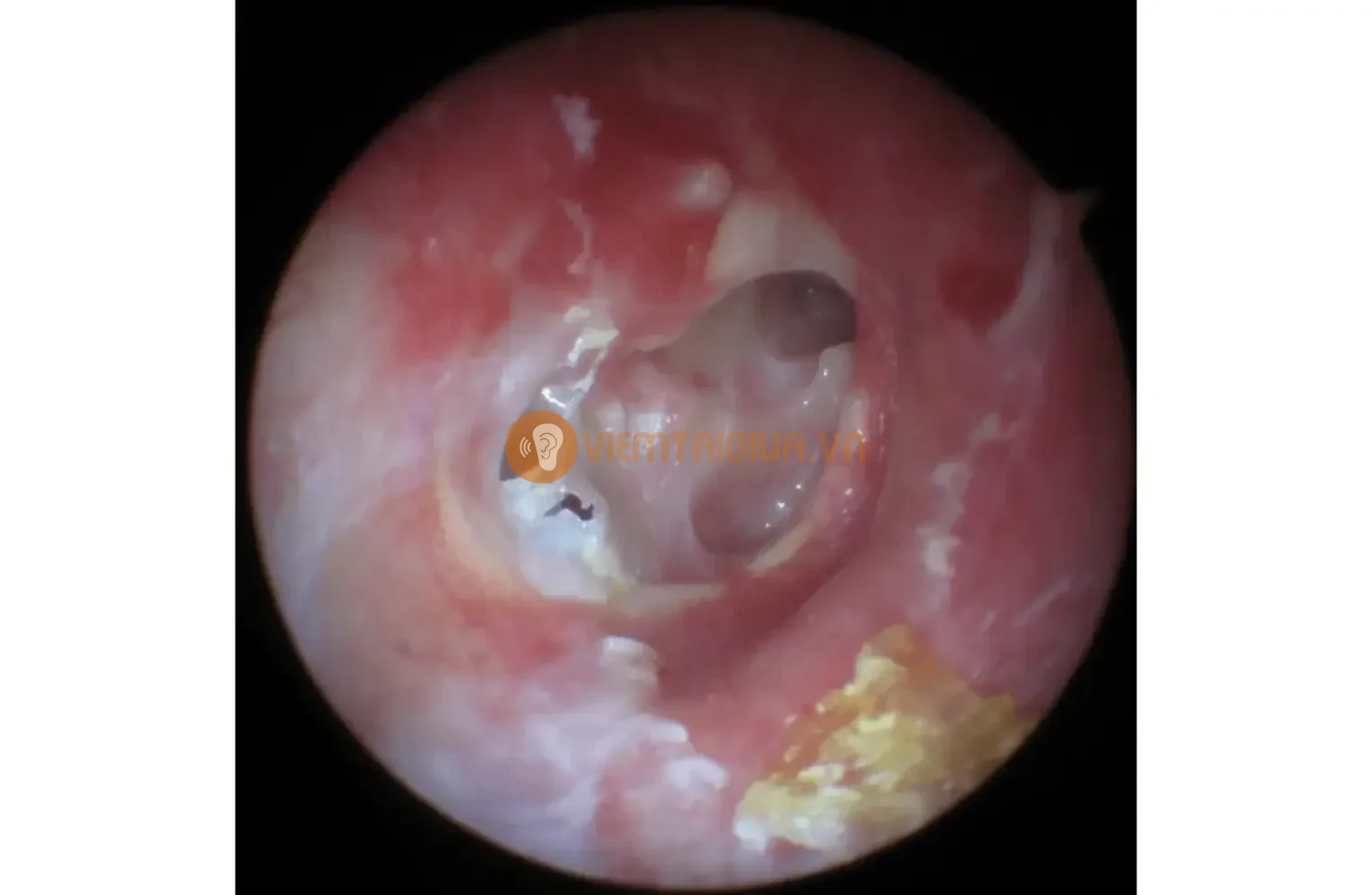 Hình ảnh thủng màng nhĩ kết hợp bệnh lý nhọt ống tai ngoài