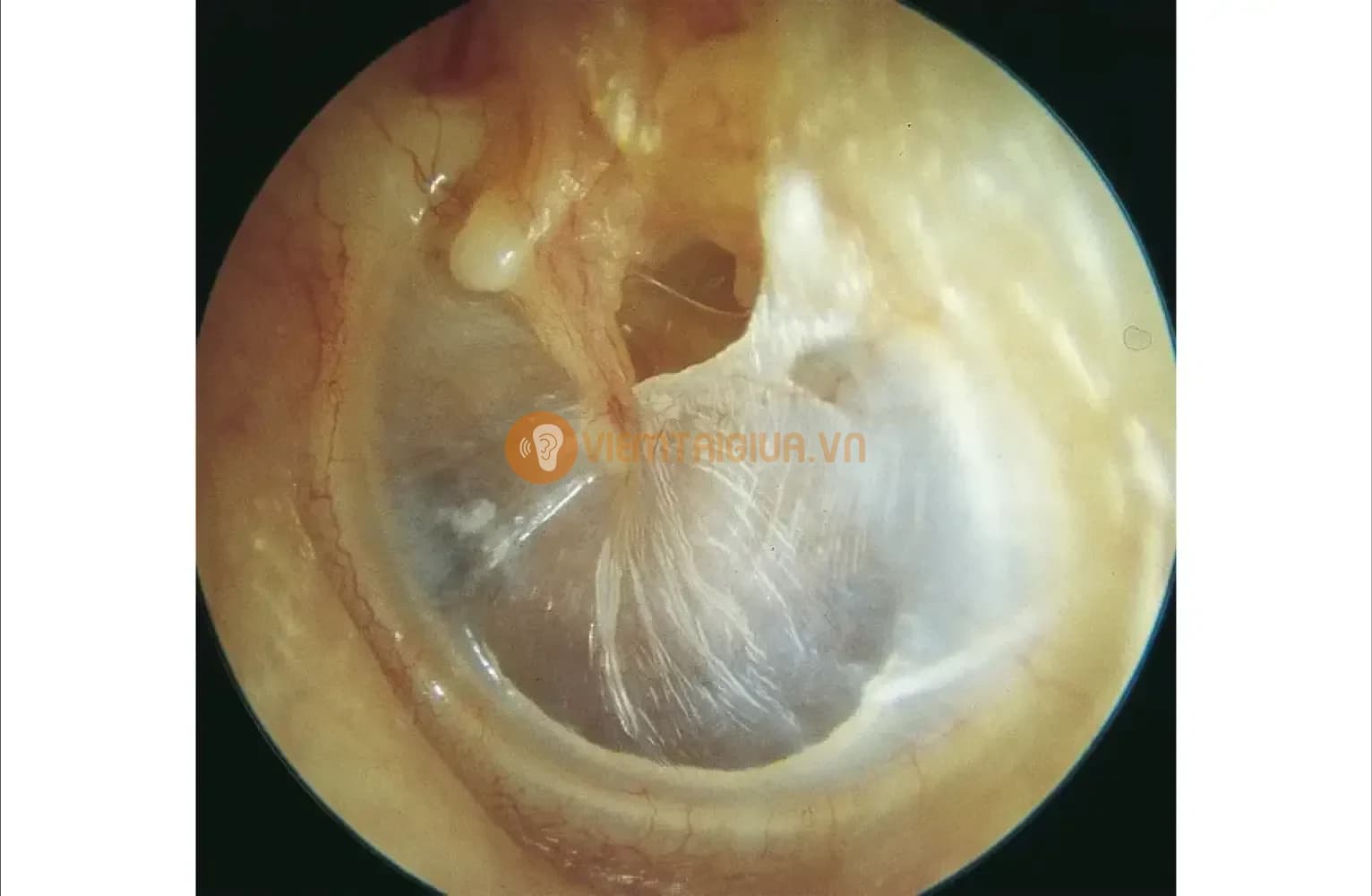 Tổn thương phần thượng nhĩ và hiện tượng xung huyết ở tai