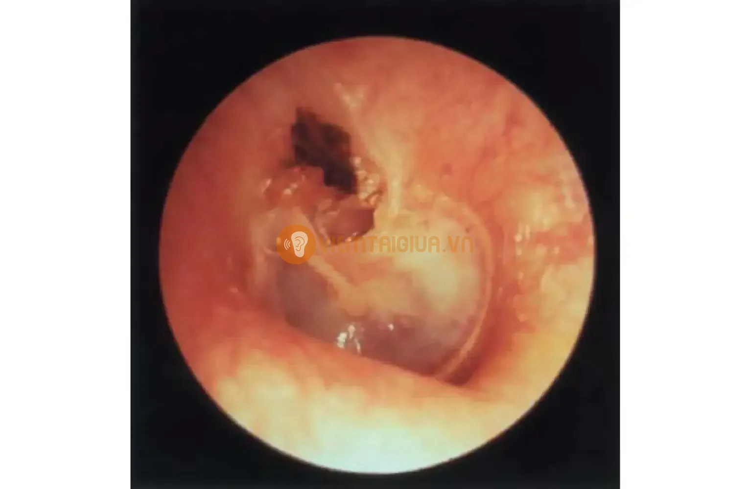 Tổn thương màng nhĩ nghi ngờ nguyên nhân do cholesteatoma - u bã tai