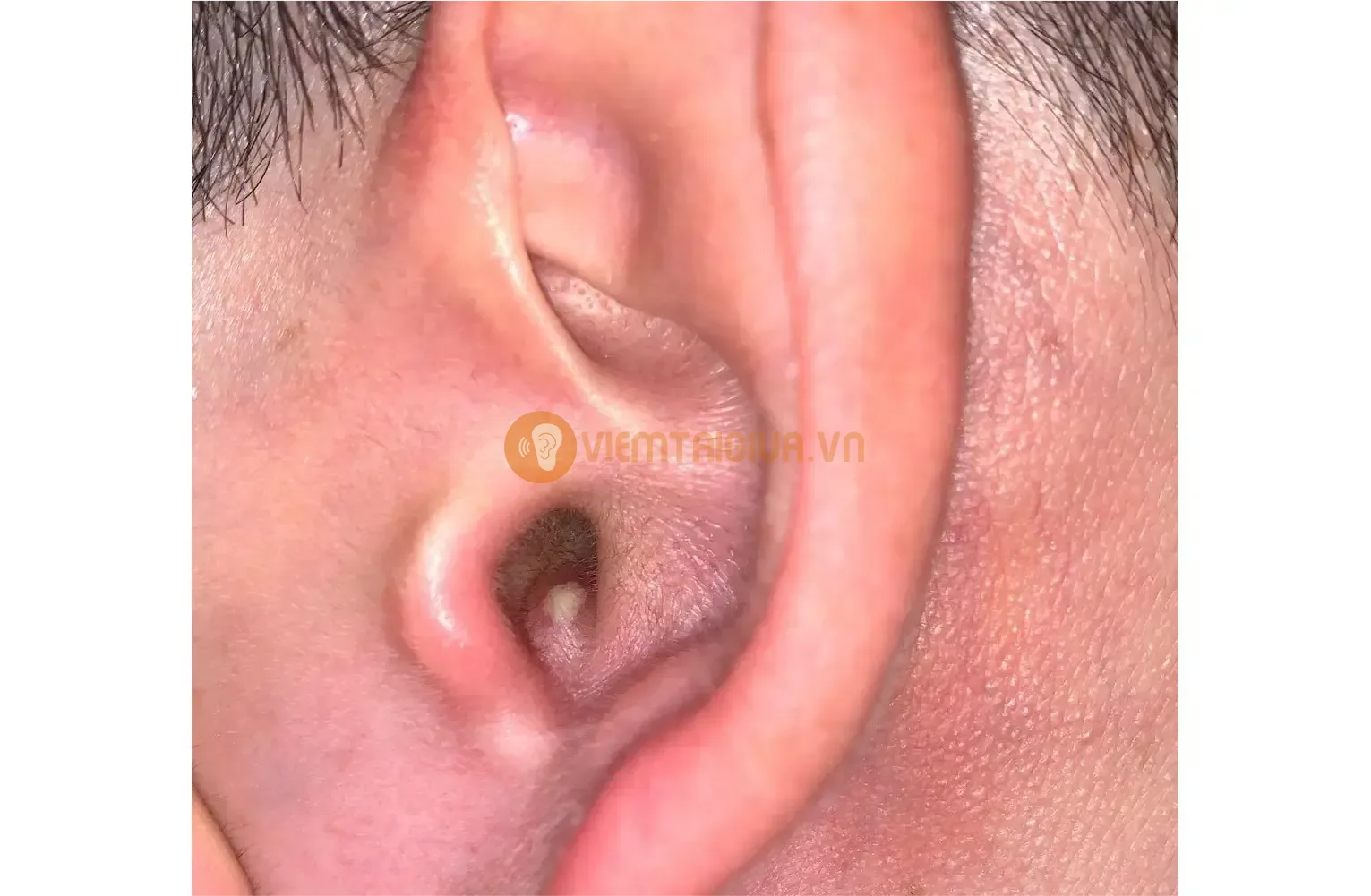 Nhọt ống tai ngoài là tình trạng nhiễm trùng cấp tính xảy ra ở ống tai ngoài