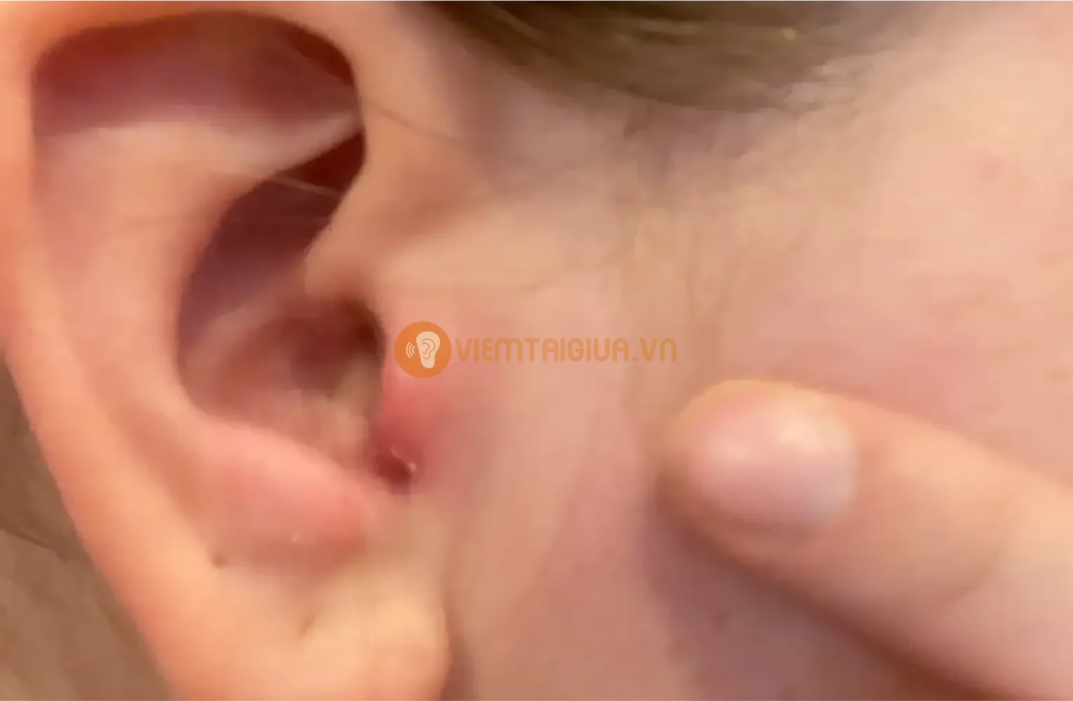 Phòng ngừa và điều trị nhọt ống tai ngoài giúp bảo vệ thính lực