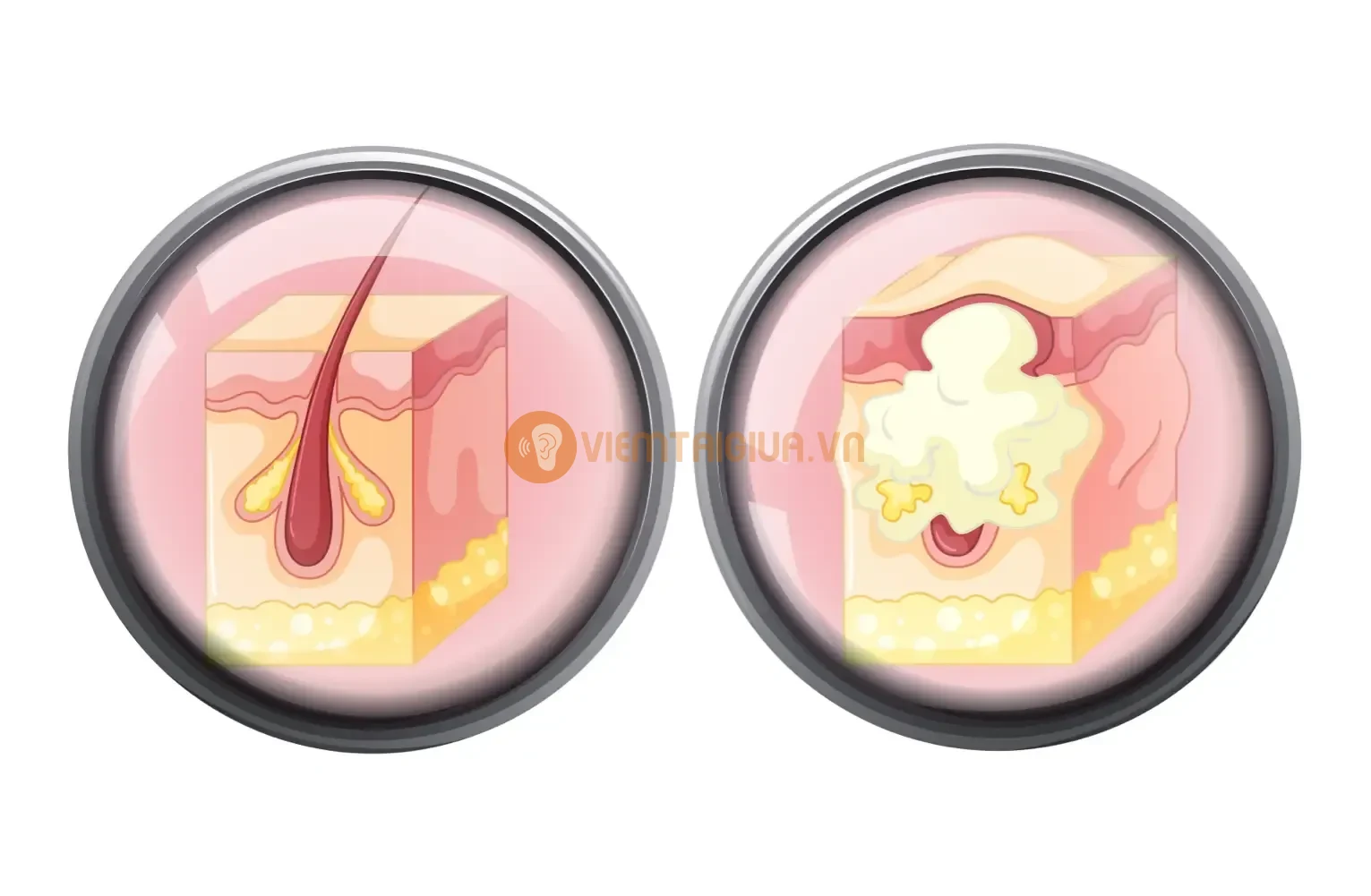 Vi khuẩn xâm nhập thông qua lỗ chân lông hoặc tuyến bã nhờn