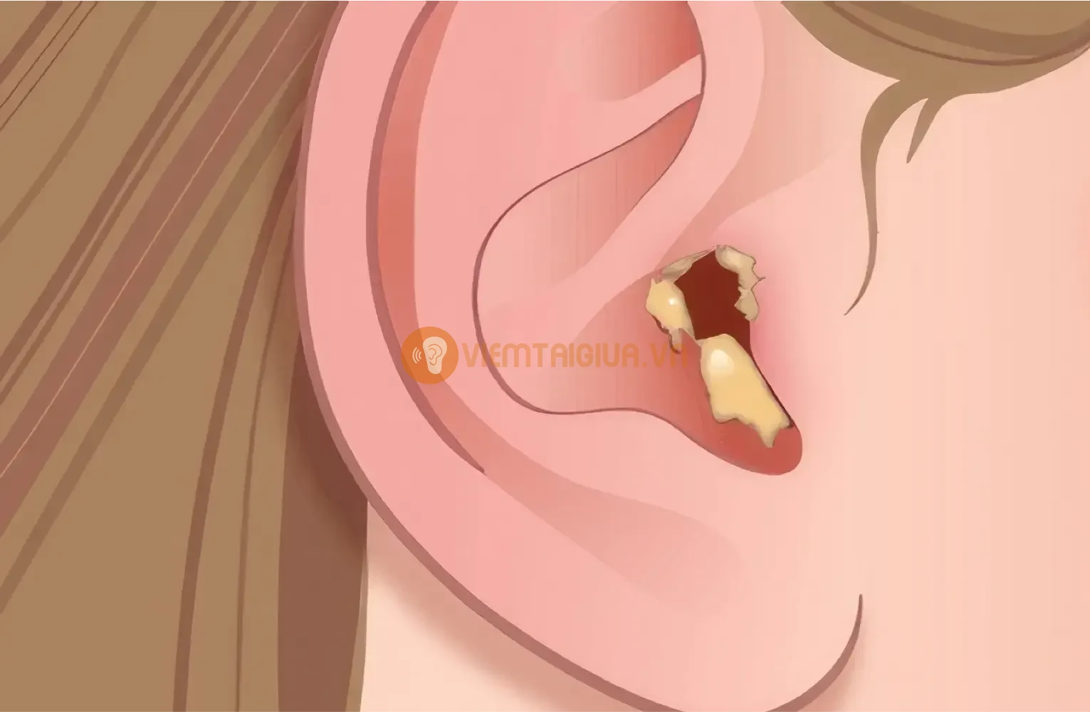 Khi nhọt bị vỡ sẽ giảm triệu chứng đau nhưng tăng nguy cơ nhiễm trùng