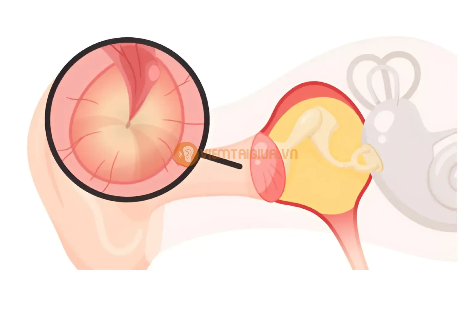 Tai giữa nằm phía sau màng nhĩ, tiếp giáp với ống Eustachian
