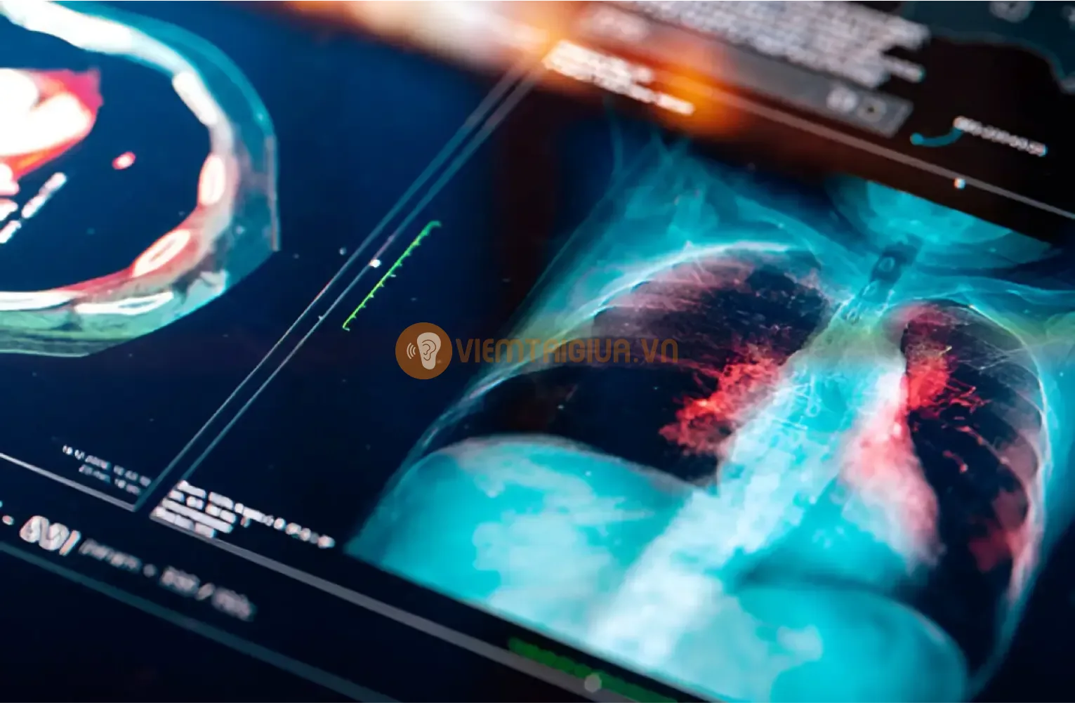Virus cúm gây ra các đợt viêm tai giữa trong mùa dịch cúm