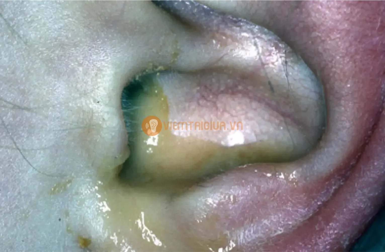 Dịch mủ có màu vàng, xanh chảy ra từ tai là dấu hiệu của viêm tai giữa có mủ