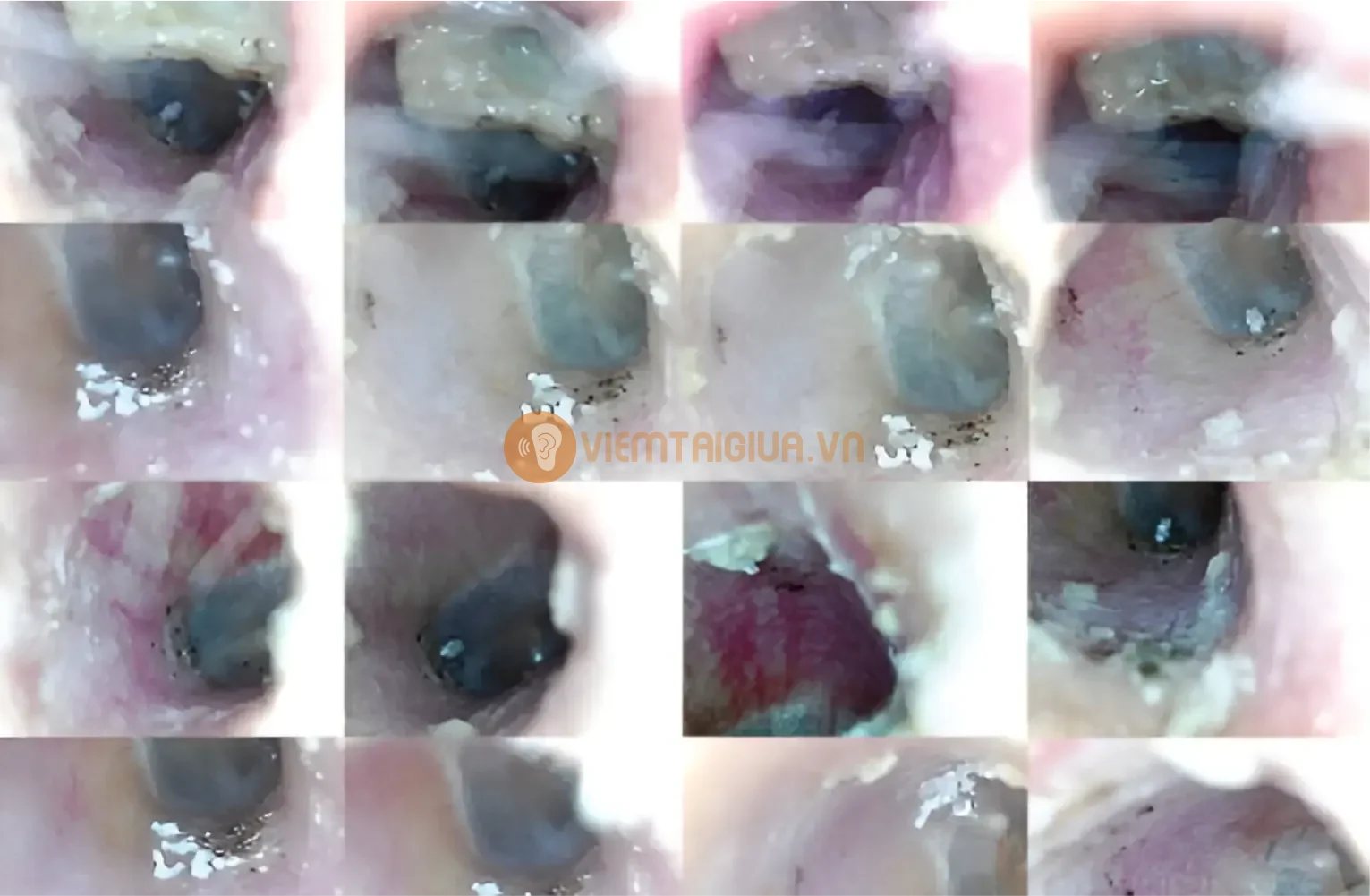 Nấm tai ngoài sẽ trở nặng nếu không được điều trị đúng cách